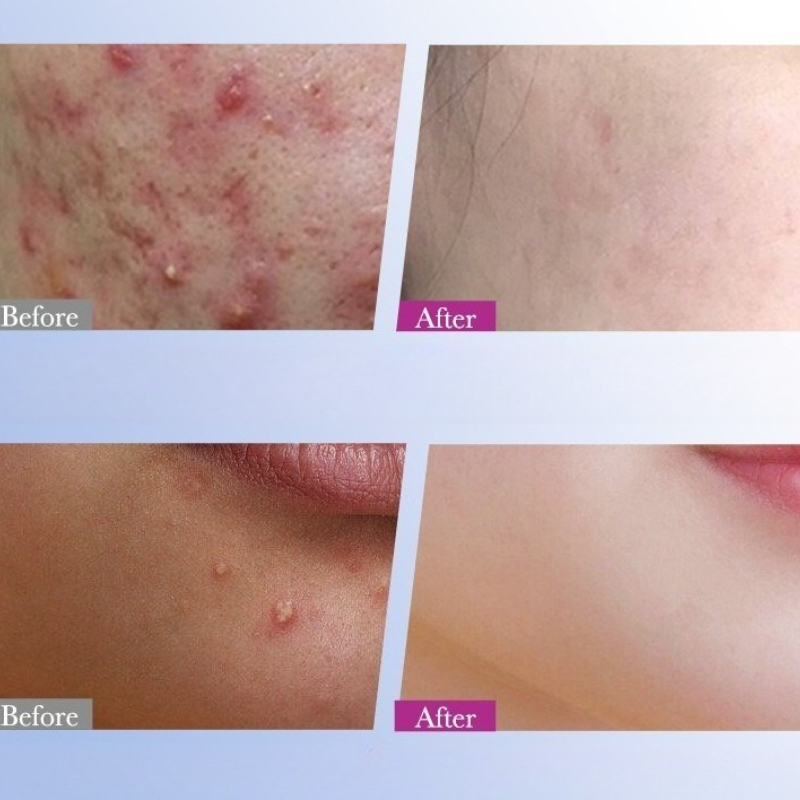 7/10/14Pcs Bunte Sterne Akne P – Skincare Qv Bewertung und Preis